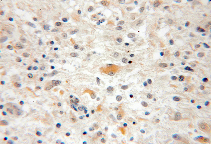 Immunohistochemical of paraffin-embedded human medulloblastoma using Catalog No:109460(CPOX antibody) at dilution of 1:100 (under 10x lens)