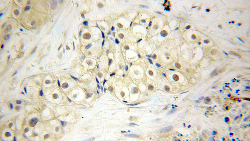 Immunohistochemical of paraffin-embedded human lung cancer using Catalog No:115025(SDCCAG1 antibody) at dilution of 1:50 (under 40x lens)