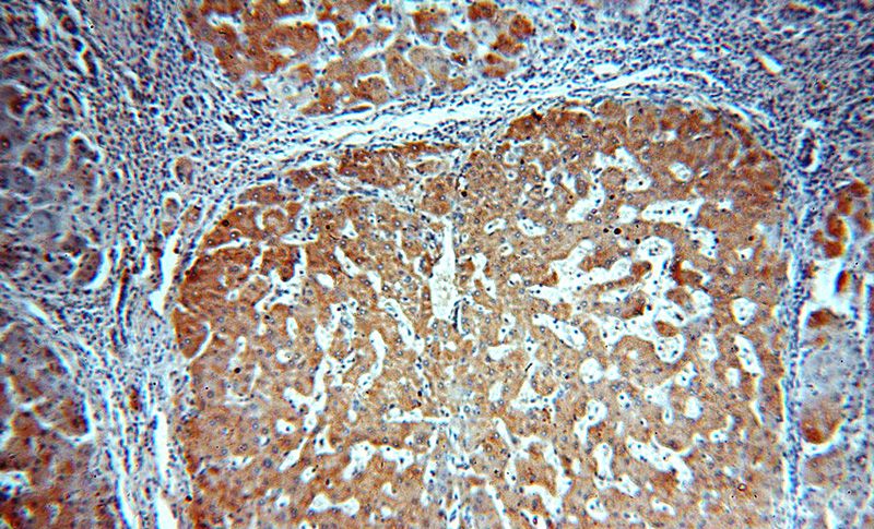 Immunohistochemical of paraffin-embedded human hepatocirrhosis using Catalog No:107714(ACTR10 antibody) at dilution of 1:100 (under 10x lens)