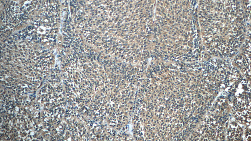Immunohistochemistry of paraffin-embedded human pituitary adenoma tissue slide using Catalog No:111219(GH1 Antibody) at dilution of 1:50 (under 10x lens)