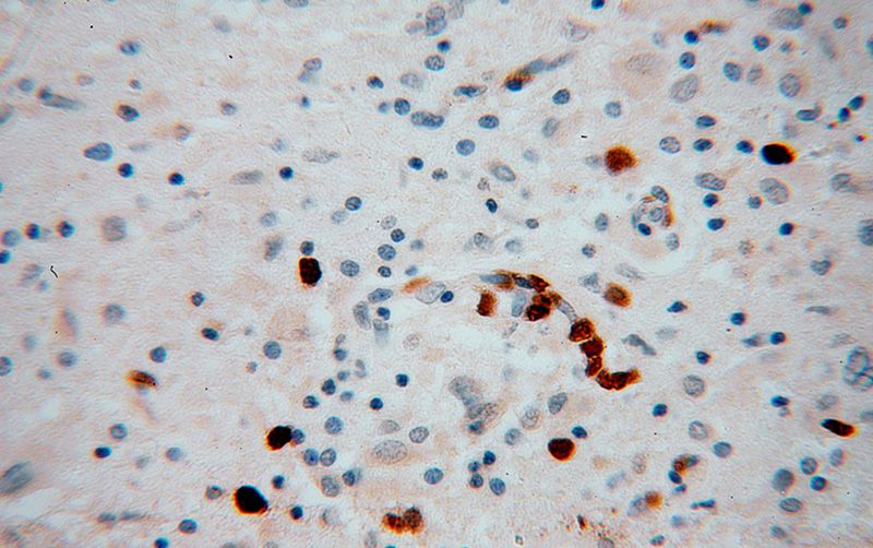 Immunohistochemical of paraffin-embedded human gliomas using Catalog No:112013(KIF3A antibody) at dilution of 1:100 (under 40x lens)