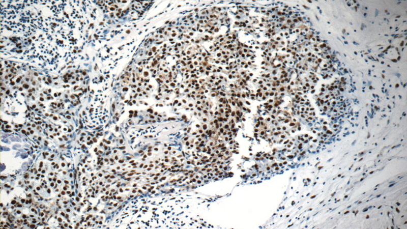 Immunohistochemistry of paraffin-embedded human breast cancer slide using Catalog No:108954(DBC1 Antibody) at dilution of 1:400