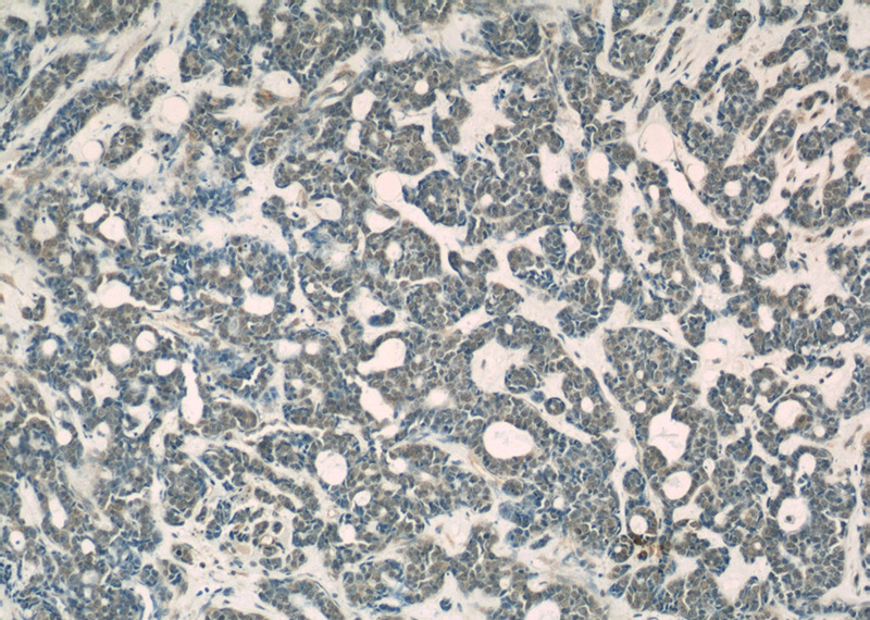 Immunohistochemical of paraffin-embedded human cervical cancer using Catalog No:107532(USP1 antibody) at dilution of 1:50 (under 10x lens)
