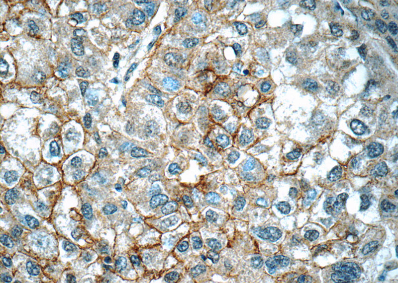 Immunohistochemistry of paraffin-embedded human liver cancer tissue slide using Catalog No:109745(CUL4A-Specific Antibody) at dilution of 1:50 (under 40x lens)