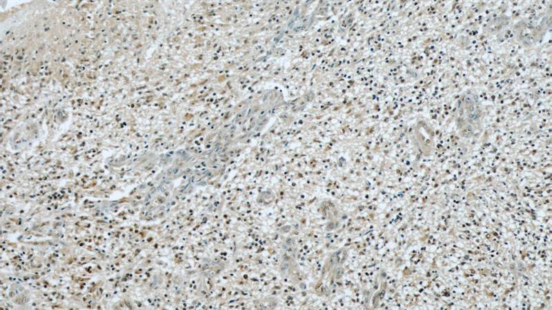 Immunohistochemical of paraffin-embedded human gliomas using Catalog No:110707(FOXO6 antibody) at dilution of 1:50 (under 10x lens)