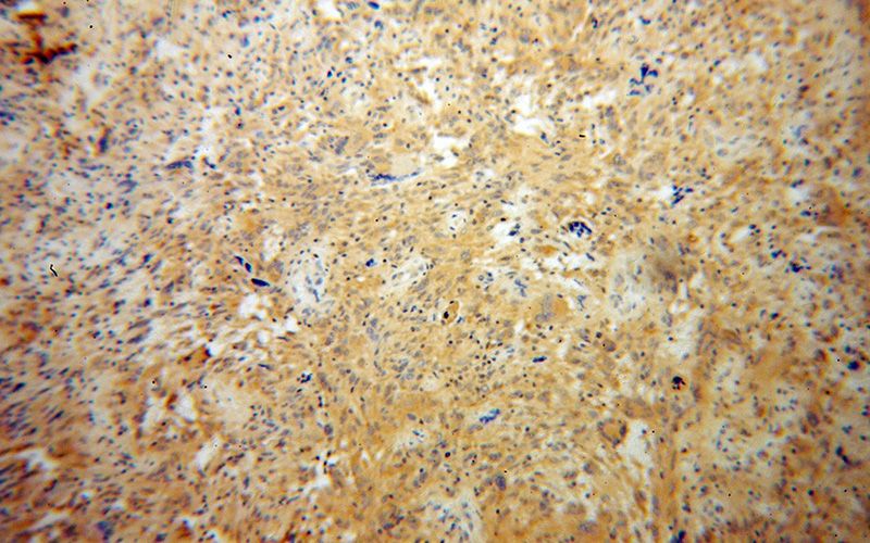 Immunohistochemical of paraffin-embedded human gliomas using Catalog No:112947(NAPB antibody) at dilution of 1:100 (under 10x lens)