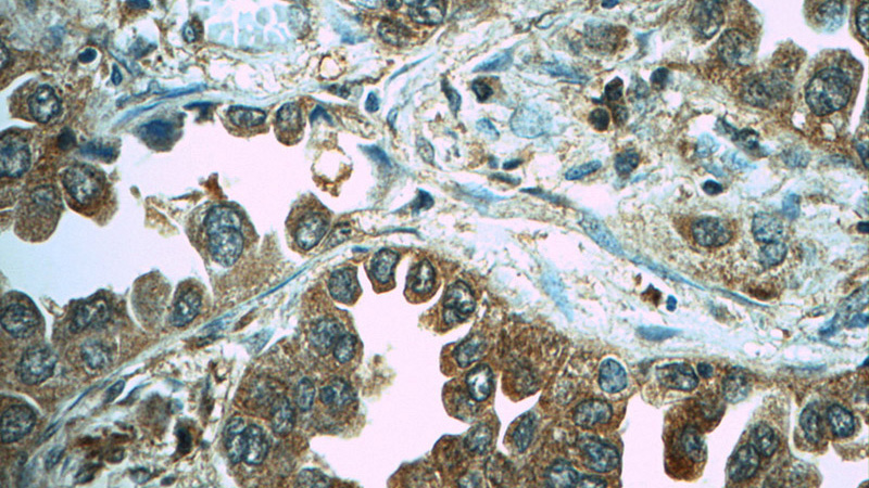 Immunohistochemistry of paraffin-embedded human lung cancer tissue slide using Catalog No:110214(KIF11 Antibody) at dilution of 1:50 (under 40x lens)