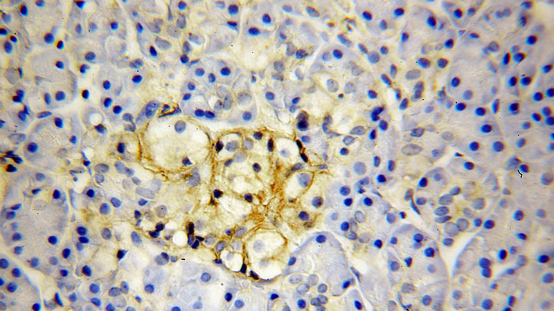 Immunohistochemical of paraffin-embedded human pancreas cancer using Catalog No:110994(GNB1 antibody) at dilution of 1:100 (under 40x lens)