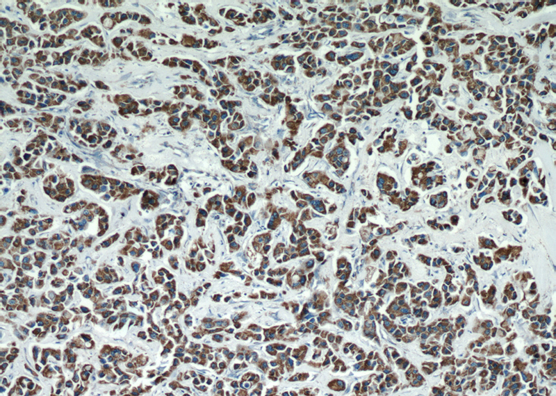 Immunohistochemical of paraffin-embedded human breast cancer using Catalog No:110731(FMO5-specific antibody) at dilution of 1:50 (under 10x lens)
