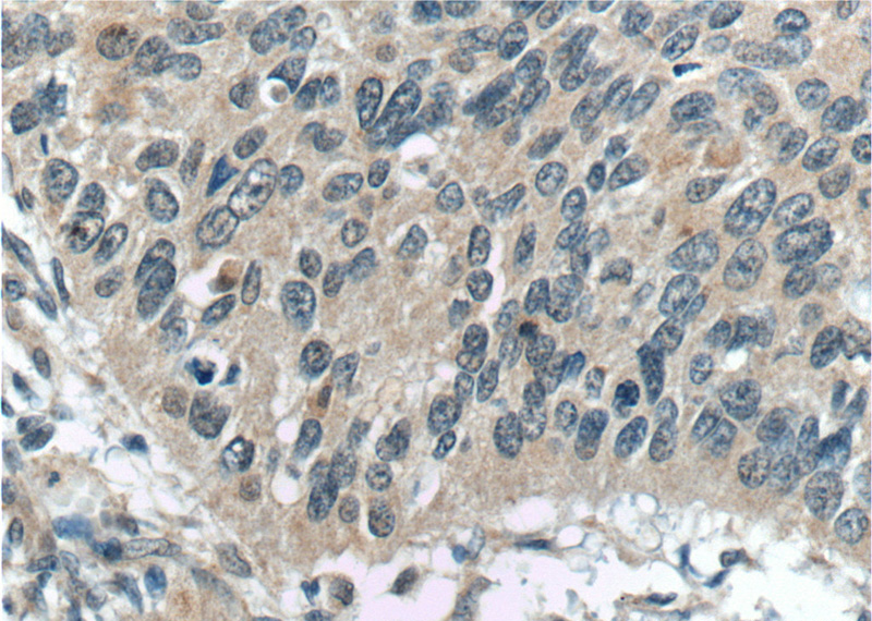 Immunohistochemistry of paraffin-embedded human cervical cancer tissue slide using Catalog No:112314(LRCH1 Antibody) at dilution of 1:50 (under 40x lens)