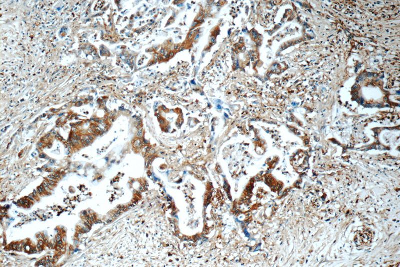 Immunohistochemistry of paraffin-embedded human pancreas cancer tissue slide using Catalog No:108932(CAP1 Antibody) at dilution of 1:50 (under 10x lens)