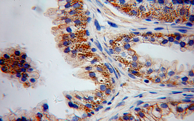 Immunohistochemical of paraffin-embedded human gliomas using Catalog No:114863(RTN3 antibody) at dilution of 1:50 (under 40x lens)
