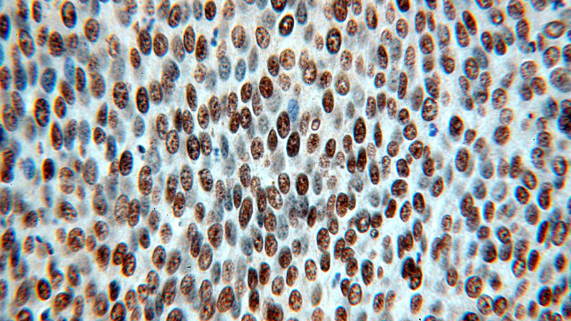 Immunohistochemical of paraffin-embedded human cervical cancer using Catalog No:115110(SENP5-Specific antibody) at dilution of 1:100 (under 40x lens)