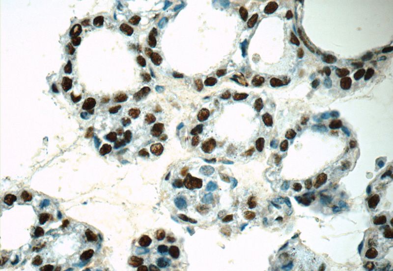 Immunohistochemistry of paraffin-embedded human thyroid tissue slide using Catalog No:111094(GMCL1 Antibody) at dilution of 1:50