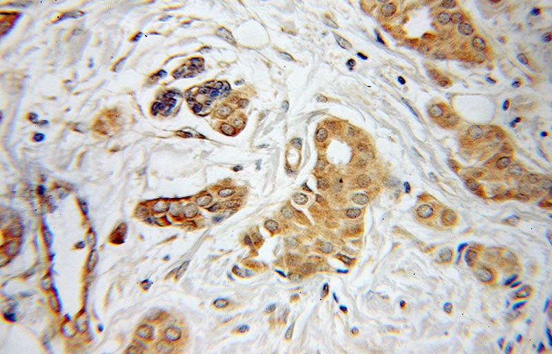 Immunohistochemical of paraffin-embedded human breast cancer using Catalog No:111814(INVS antibody) at dilution of 1:100 (under 25x lens)