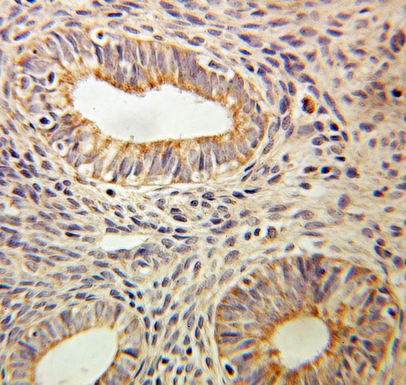 Immunohistochemical of paraffin-embedded human ovary tumor using Catalog No:109131(CD59 antibody) at dilution of 1:100 (under 10x lens)