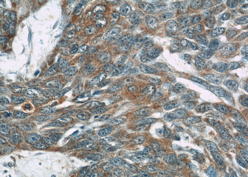 Immunohistochemistry of paraffin-embedded human skin cancer tissue slide using Catalog No:113461(OAS3 Antibody) at dilution of 1:50 (under 40x lens)