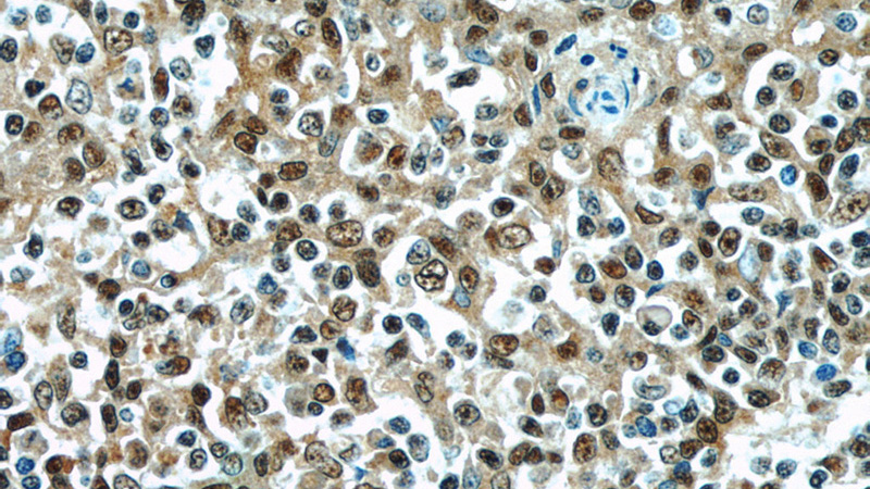 Immunohistochemistry of paraffin-embedded human tonsillitis slide using Catalog No:112549(MCL1 Antibody) at dilution of 1:50