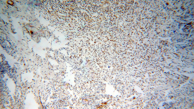 Immunohistochemical of paraffin-embedded human breast cancer using Catalog No:116113(THUMPD1 antibody) at dilution of 1:100 (under 10x lens)