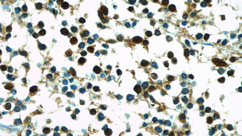 Immunohistochemistry of paraffin-embedded human lung cancer slide using Catalog No:114400(PSMD4 Antibody) at dilution of 1:50