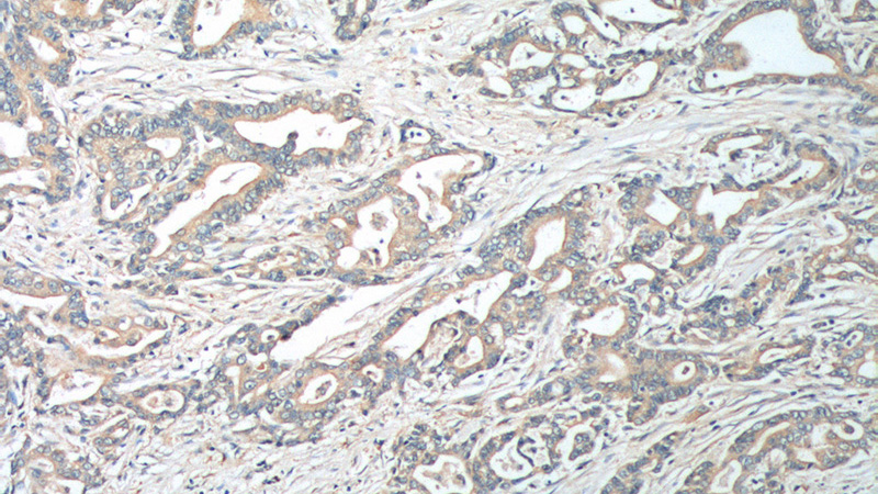 Immunohistochemistry of paraffin-embedded human pancreas cancer tissue slide using Catalog No:110347(PRocR Antibody) at dilution of 1:100 (under 10x lens).