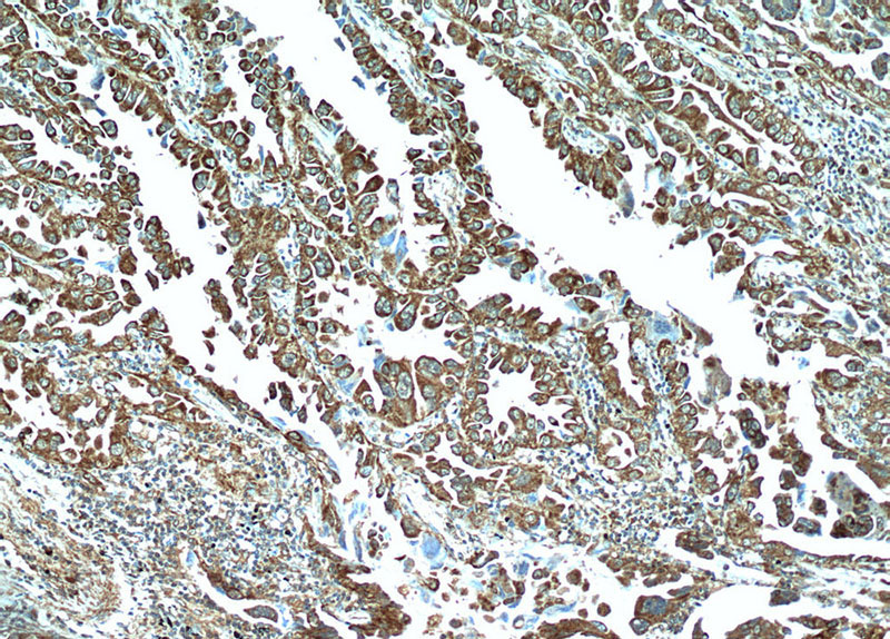 Immunohistochemical of paraffin-embedded human lung cancer using Catalog No:114156(PPPDE1 antibody) at dilution of 1:50 (under 10x lens)