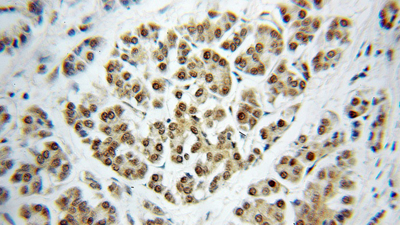 Immunohistochemical of paraffin-embedded human pancreas cancer using Catalog No:109952(DNAJC7 antibody) at dilution of 1:50 (under 10x lens)