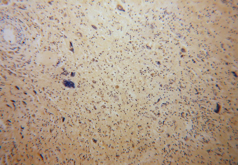 Immunohistochemical of paraffin-embedded human gliomas using Catalog No:114722(RMI1 antibody) at dilution of 1:100 (under 10x lens)