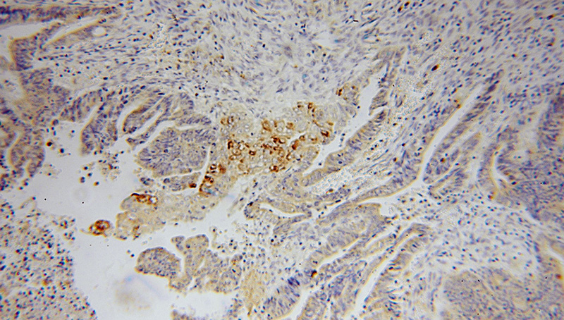 Immunohistochemical of paraffin-embedded human colon cancer using Catalog No:113923(PLA2G12A antibody) at dilution of 1:50 (under 10x lens)