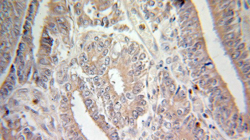 Immunohistochemical of paraffin-embedded human colon cancer using Catalog No:116588(USP11 antibody) at dilution of 1:100 (under 25x lens)
