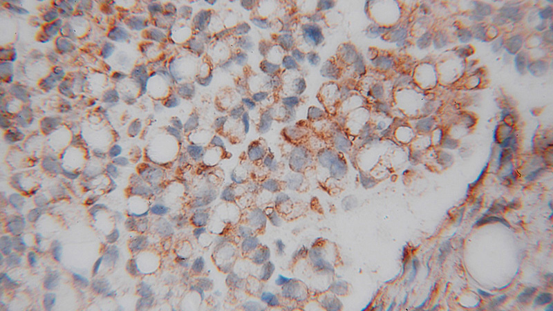 Immunohistochemical of paraffin-embedded human ovary tumor using Catalog No:112284(LMOD1 antibody) at dilution of 1:50 (under 40x lens)