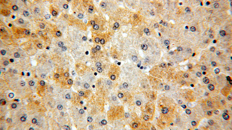 Immunohistochemical of paraffin-embedded human liver using Catalog No:115037(SAA1 antibody) at dilution of 1:50 (under 40x lens)