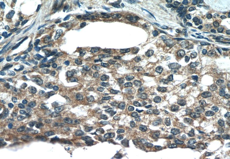 Immunohistochemistry of paraffin-embedded human prostate cancer tissue slide using Catalog No:116089(TMEFF2 Antibody) at dilution of 1:100 (under 40x lens)