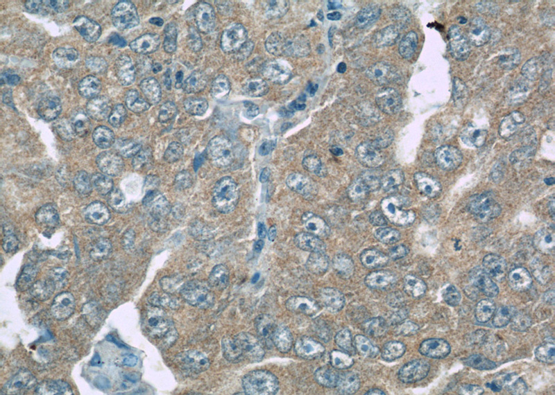 Immunohistochemistry of paraffin-embedded human lung cancer slide using Catalog No:114784(ROMO1 Antibody) at dilution of 1:50
