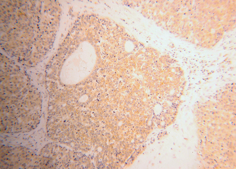 Immunohistochemical of paraffin-embedded human liver cancer using Catalog No:114895(RPL39 antibody) at dilution of 1:100 (under 10x lens)
