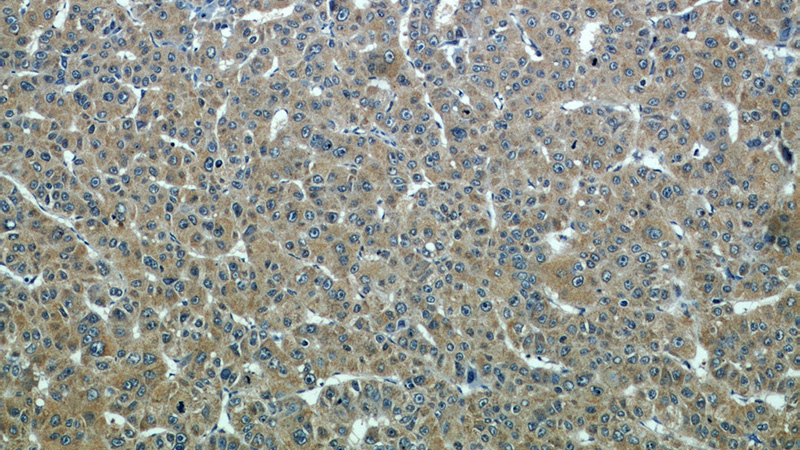 Immunohistochemical of paraffin-embedded human liver cancer using Catalog No:117299(Tubulin-Alpha antibody) at dilution of 1:100 (under 10x lens)