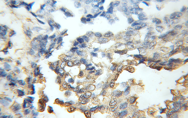 Immunohistochemical of paraffin-embedded human breast cancer using Catalog No:109172(CDR2 antibody) at dilution of 1:50 (under 10x lens)