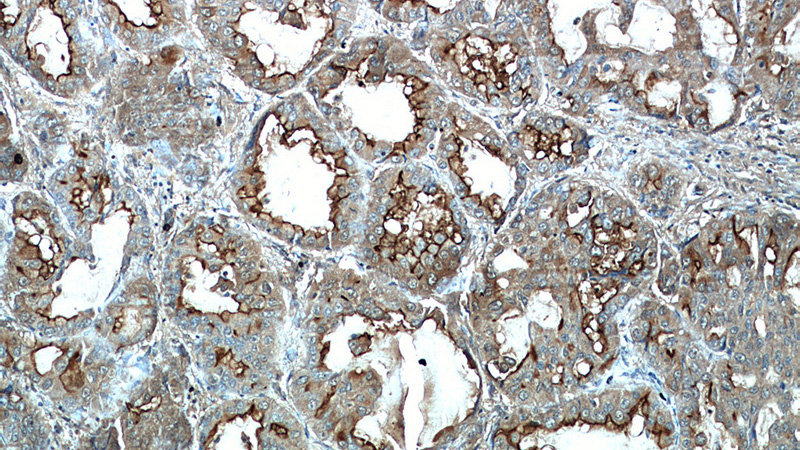 Immunohistochemical of paraffin-embedded human lung cancer using Catalog No:112888(CA15-3,MUC1 antibody) at dilution of 1:50 (under 10x lens)