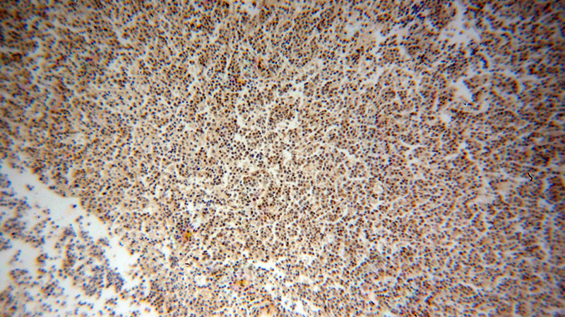 Immunohistochemical of paraffin-embedded human lymphoma using Catalog No:116724(VBP1 antibody) at dilution of 1:100 (under 10x lens)