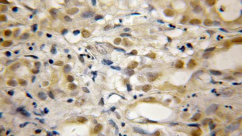 Immunohistochemical of paraffin-embedded human pancreas cancer using Catalog No:114677(RECQL5 antibody) at dilution of 1:50 (under 10x lens)