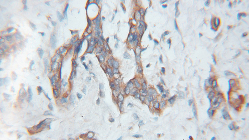 Immunohistochemical of paraffin-embedded human pancreas cancer using Catalog No:115001(SCMH1 antibody) at dilution of 1:100 (under 10x lens)