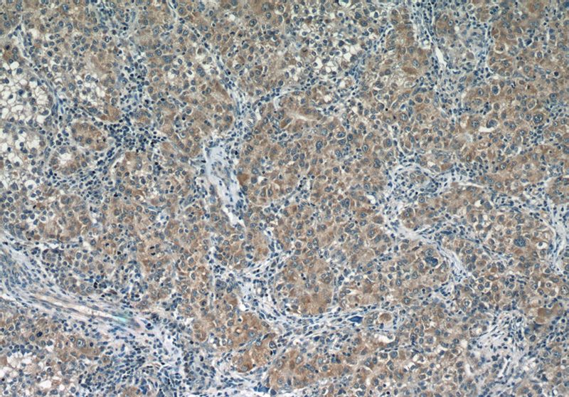 Immunohistochemistry of paraffin-embedded human liver cancer slide using Catalog No:111081(GLUL Antibody) at dilution of 1:50