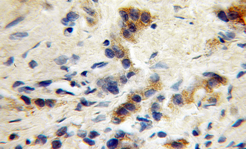 Immunohistochemical of paraffin-embedded human gliomas using Catalog No:110812(GABRG1 antibody) at dilution of 1:100 (under 40x lens)