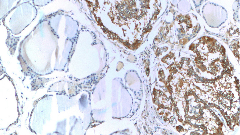 Immunohistochemistry of paraffin-embedded human thyroid cancer tissue slide using Catalog No:107286(Galectin 3 Antibody) at dilution of 1:100 (under 10x lens)