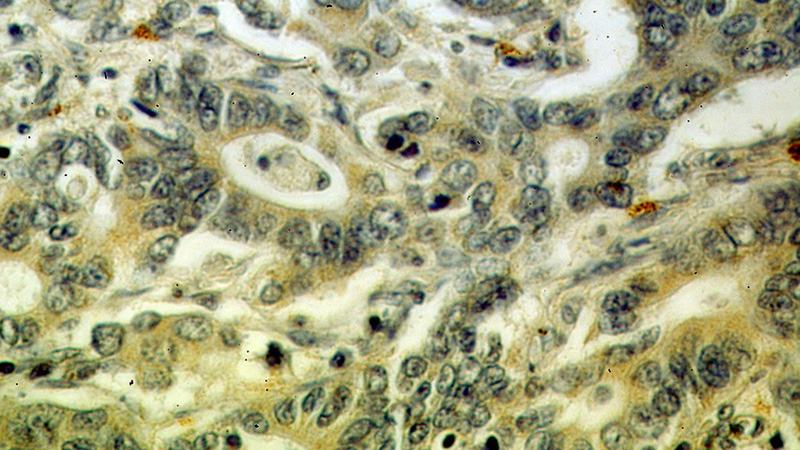 Immunohistochemical of paraffin-embedded human stomach cancer using Catalog No:111637(IHH antibody) at dilution of 1:50 (under 40x lens)