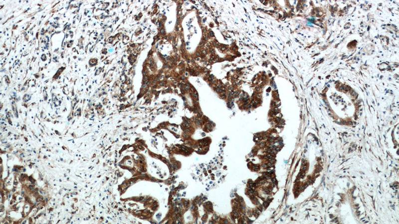 Immunohistochemical of paraffin-embedded human pancreas cancer using Catalog No:113551(P4HA2 antibody) at dilution of 1:50 (under 10x lens)