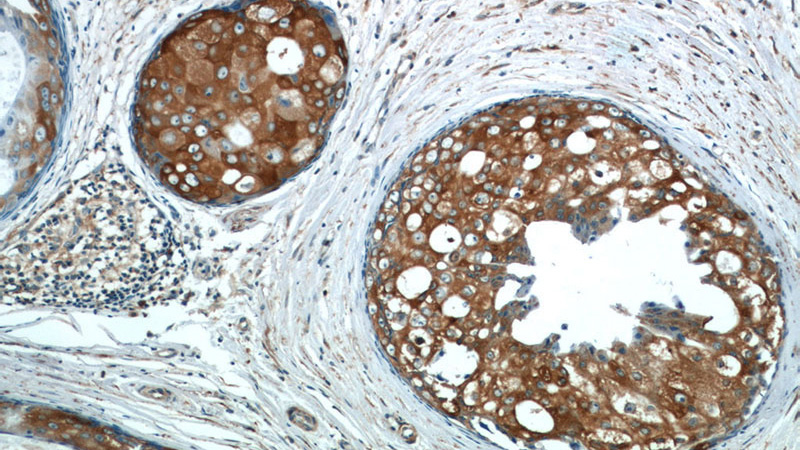 Immunohistochemistry of paraffin-embedded human breast cancer tissue slide using Catalog No:115593(SRP54 Antibody) at dilution of 1:50 (under 10x lens)