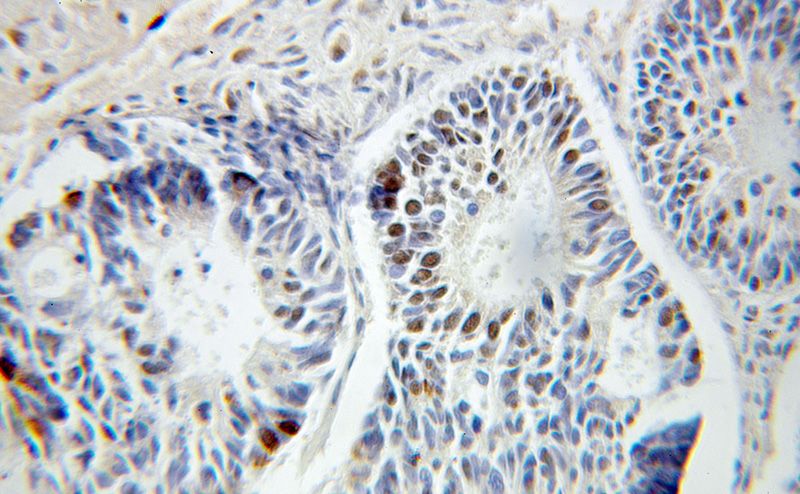 Immunohistochemical of paraffin-embedded human ovary tumor using Catalog No:113705(PELO antibody) at dilution of 1:100 (under 25x lens)
