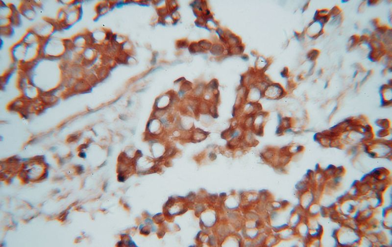 Immunohistochemical of paraffin-embedded human ovary tumor using Catalog No:108843(CAPZA1 antibody) at dilution of 1:50 (under 40x lens)