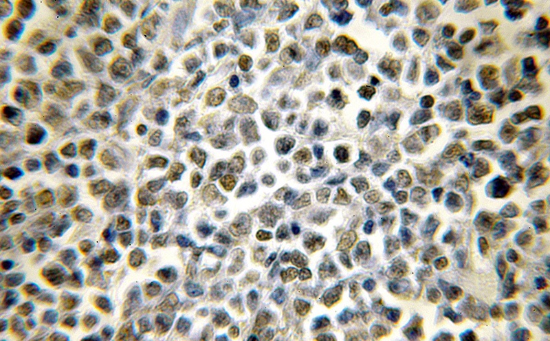 Immunohistochemical of paraffin-embedded human lymphoma using Catalog No:109218(CHD2 antibody) at dilution of 1:50 (under 10x lens)